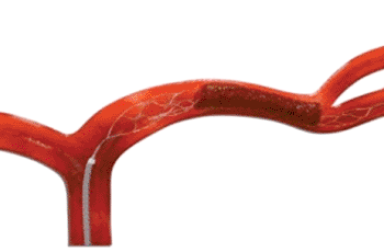Image: Illustration of the Trevo Pro Retriever engaging a thrombus (Photo courtesy of Stryker). Image: Illustration of the Trevo Pro Retriever engaging a thrombus (Photo courtesy of Stryker).